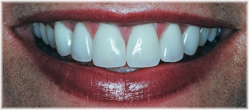 West LKN Dentistry, P.A. - Dental Implants Denver NC