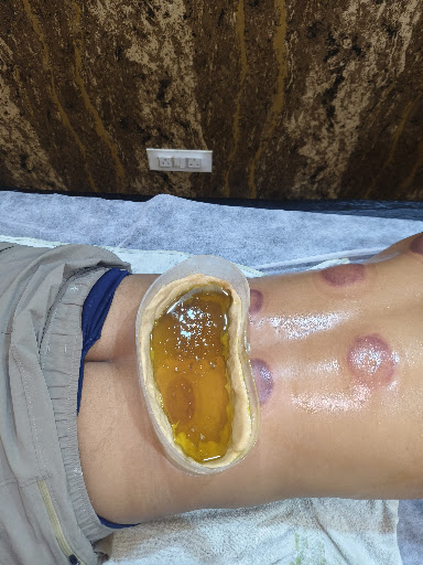 Kati Basti therapy for slip disc post image