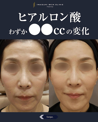プラズマシャワー - 東京・六本木の美容皮膚科なら今泉スキンクリニック
