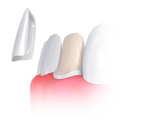 Carillas Dentales Las Rozas - Thumbnail