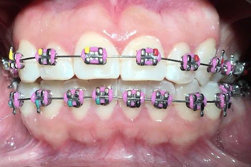Dentistas en Atizapán de Zaragoza | Clinica Dental Atlanco - Thumbnail