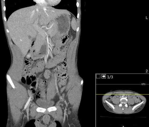 In Radiology practice, abdominal imaging plays a key role in early detection and accurate assessm…