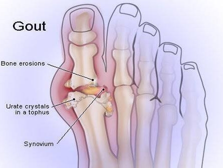 Homeopathic treatment for gout post image
