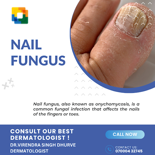 Early symptoms of nail fungus include yellow or white spots under the nail tip, thickening of the…