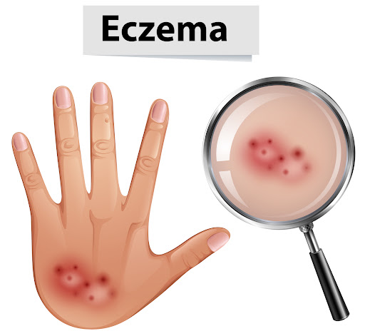 Eczema is a common skin condition that can cause dryness, itching, redness, and irritation. Sympt… post image
