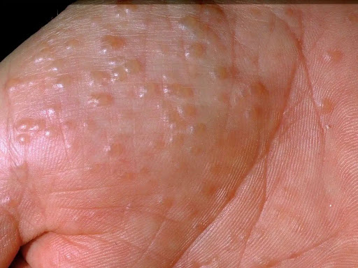 Struggling with itchy blisters, hand eczema, or recurring sk