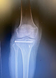 Photo n°17 de Dr Jonathan Hourtal - Chirurgie du Genou Toulouse - Chirurgie de la Hanche - Chirurgie Orthopédique à Cornebarrieu (Chirurgien orthopédiste)