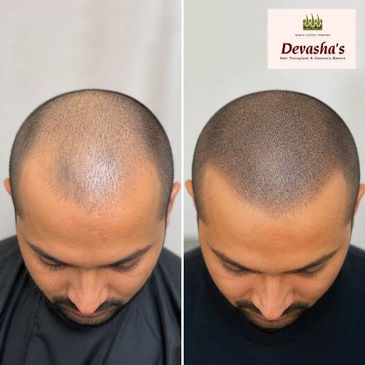 Struggling with thinning hair or visible scalp but not ready for surgery? Scalp micropigmentation… post image
