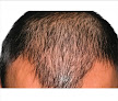 Hair transplant clinic Global Center For Hair Restoration in Nashville