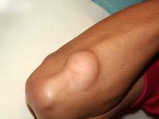 LIPOMA  post image