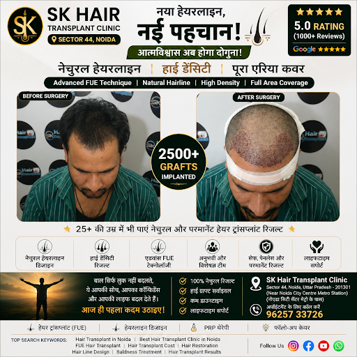 SK Hair Transplant Clinic in Sector 44, Noida NCR, provides innovative baldness treatments and ha… post image