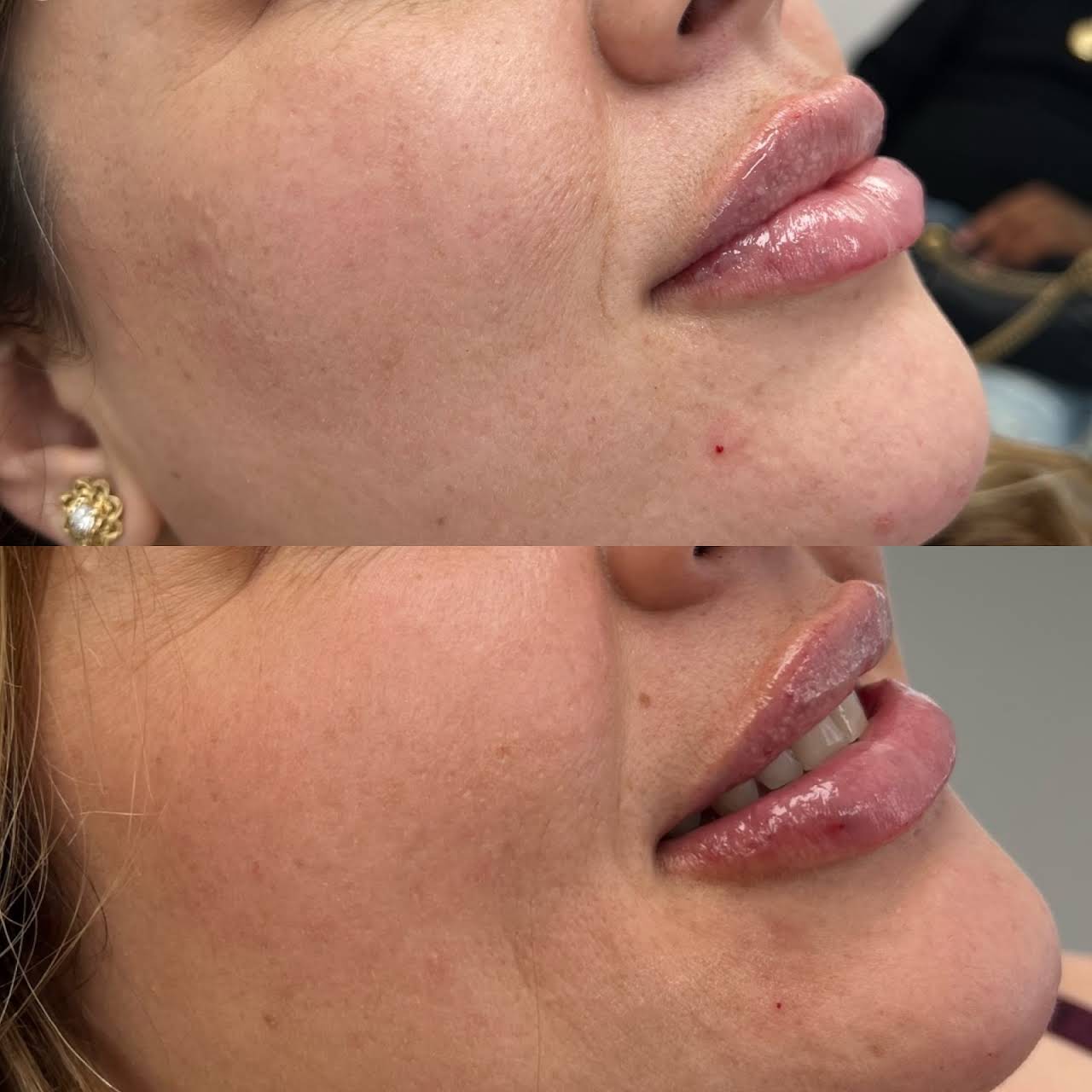 The 30-Second Trick For Botox Beverly Hills - Botox Injection Burbank thumbnail