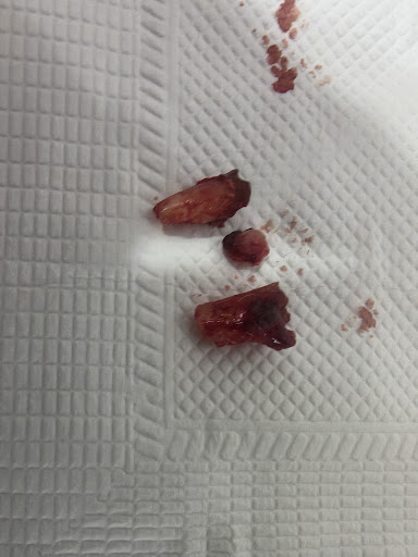 Tooth extraction post image