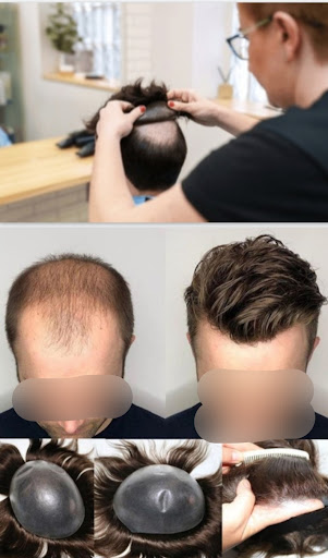 MINE THE FAMILY SALON is a leading hair restoration salon specializing in natural-looking hair pa… post image