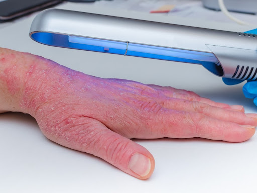 🛑 Anyone dealing with eczema knows how debilitating the disease can be. It’s miserable to live w…