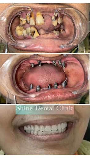 Full mouth rehabilitation / Teeth fixation permanent with implant support. post image