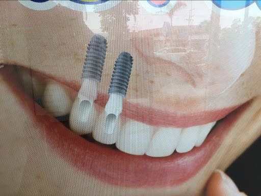 Odontología Integral Tepic; Implantes Dentales, Rehabilitación Bucal, Endodoncia. - Thumbnail