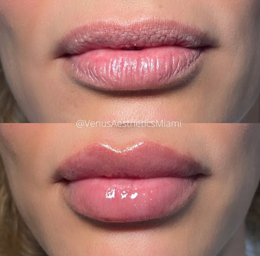 Venus Aesthetics Miami