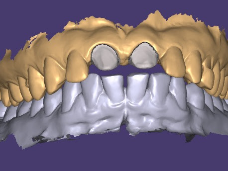 Digital impressions are dental scans taken with 3D scanning technology. The digital impression sy…