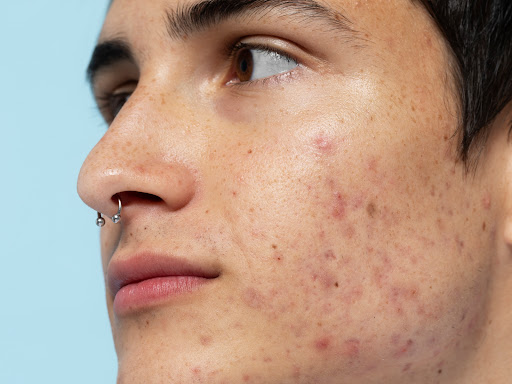Acne requires a combination of medication, lifestyle changes, and sometimes professional interven… post image