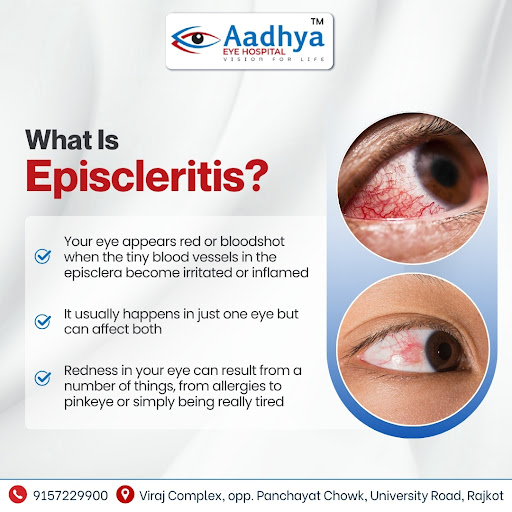 Episcleritis is a common condition that causes redness or bloodshot appearance in the eye due to… post image