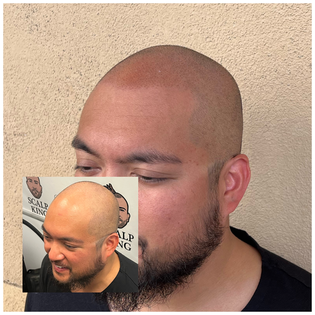 Scalp King - Hair tattoo | Scalp micropigmentation (SMP) clinic 4