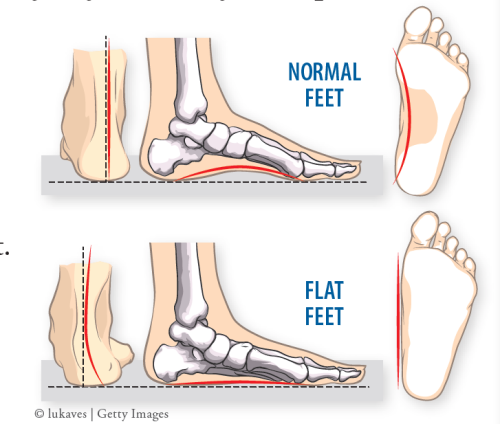 Struggling with arch pain or fatigue after walking? You might be dealing with flat feet (flatfoot… post image