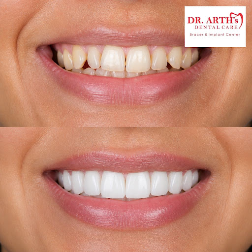 Dreaming of a brighter, more confident smile? At Dr Arths Dental Care Braces & Implant Center in… post image