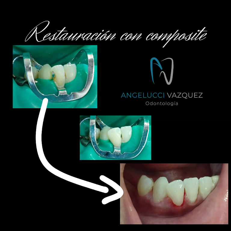 Férulas para el Bruxismo  Dentistas Arganzuela - Ortodoncia e implantes  Madrid - Clínica Dental Rocío Martínez Dentistas Arganzuela – Ortodoncia e  implantes Madrid – Clínica Dental Rocío Martínez