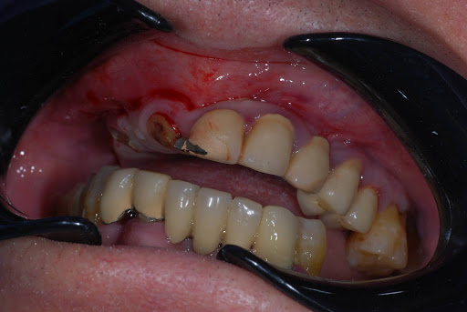 Dental Tiberinus - Thumbnail