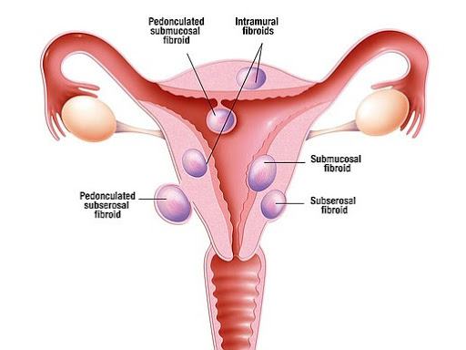 FIBROID post image