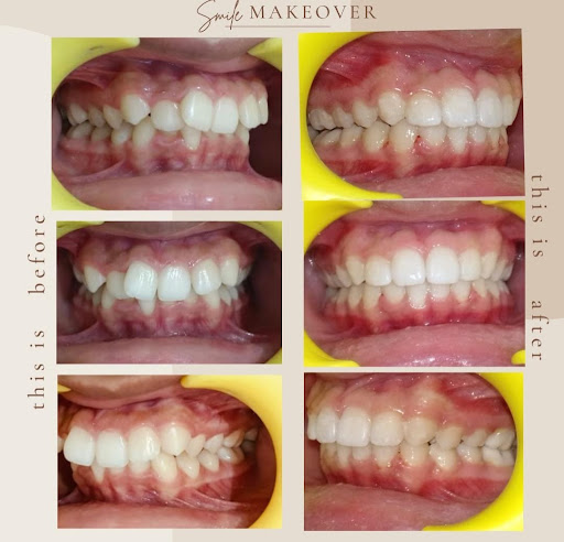 🦷 Braces Treatment – Before & After post image