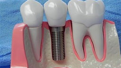 Benowa Mansions Dental Implants & Periodontal Practice - Dr.Latcham Neil