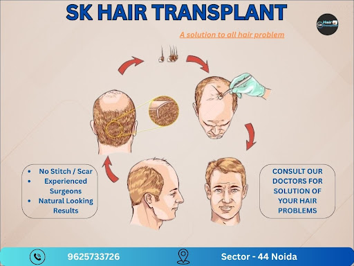 Are you struggling with hair loss or baldness? Visit SK Hair Transplant Clinic in Sector 44, Noid… post image