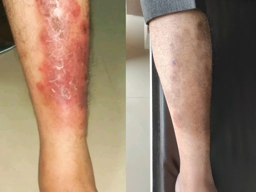 Eczema cure with homoeopathic treatment post image