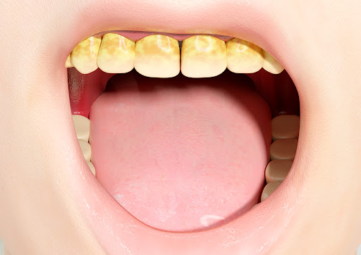 Amelogenesis refers to the process of enamel formation in the teeth. Enamel is the hard, outer la…