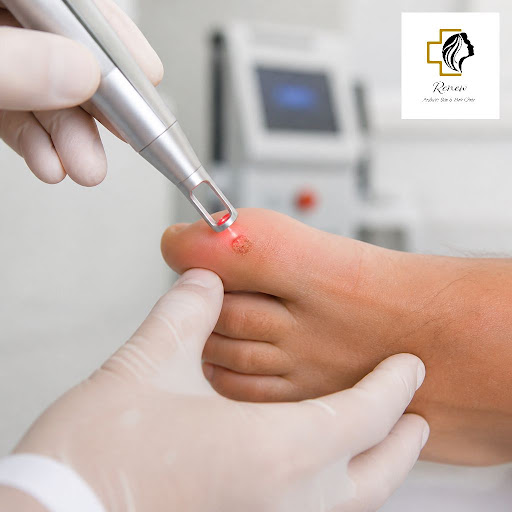Stubborn warts on your face, hands or feet? At Renew Aesthetics and Renew Dental in Royapettah, C… post image