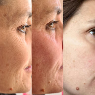 Miss Dalya Beauty - Microneedling | Hydra-beauté | Lifting Colombien à Athis-Mons