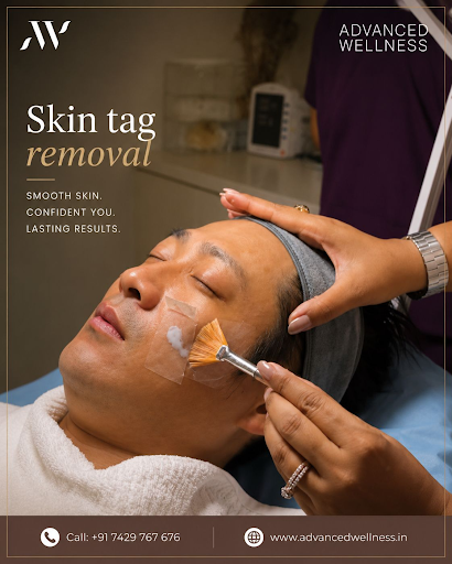 Skin Tag Removal Treatment | Skincare Treatments by Advanced Wellness - Skin, Laser, PRP and Hair…