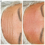 Esthetic Repair à Briançon