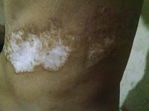 Cured within 2 months (Dr Soumya Dey's Clinic desk)  post image
