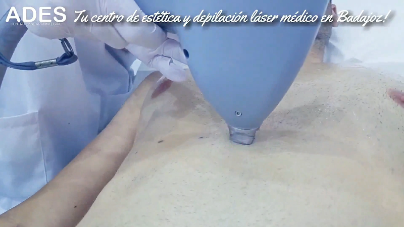 Láser Diodo y Estética ADES