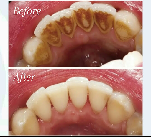 Cleaning & polishing at 400/-Rs Only