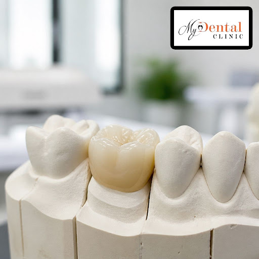 Dreaming of a confident smile with teeth that look and feel real? At My Dental Clinic - Dr. Neha… post image