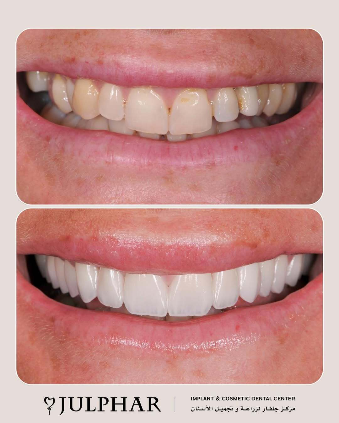 Julphar Implant & Cosmetic Dental Center - AlHamra Branch - صورة 2