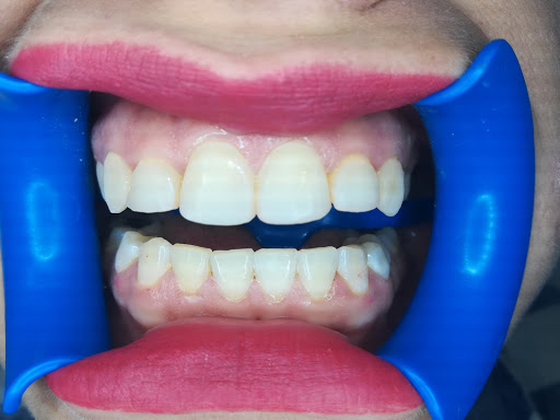 Dental Krysli - Thumbnail