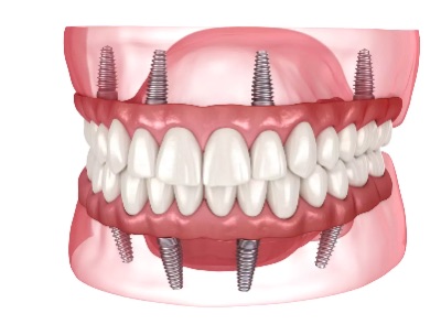 🦷 **Dental Implant Treatment Options** post image