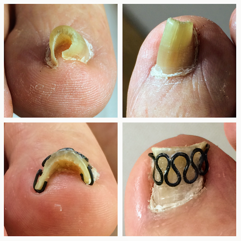 福岡宗像巻き爪矯正センター（かつきカイロプラクティック内）