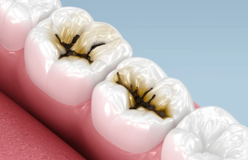 Dental caries, commonly known as tooth decay or cavities, occurs when acids gradually damage the…