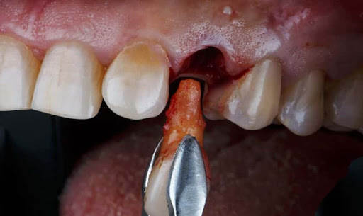 Why is it necessary? ✅ Severe decay beyond repair by Micro-RCT. ✅ Advanced gum disease or loose t… post image